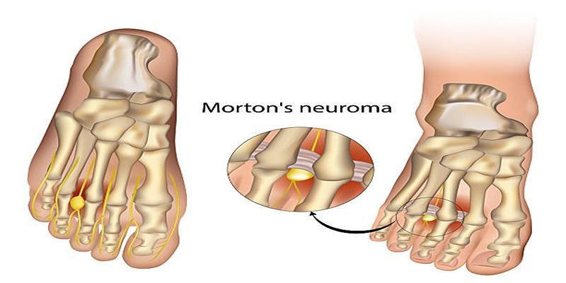 Finding Freedom from Morton’s Neuroma: Steps to Soothe Your Feet